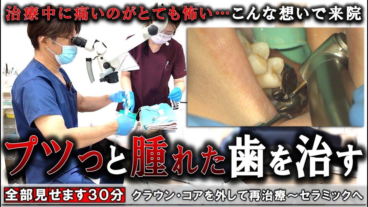 All in 30 minutes] Fixing a swollen tooth! From retreatment to