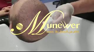 طريقة التقشير بعد عملية زراعة الشعر..