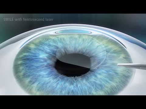 Bezbolestná operácia očí v IVIO CLINIC - SMILE