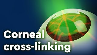 Corneal Collagen Cross-linking and Keratoconus Treatment