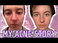 IS ACCUTANE WORTH IT? | My Acne Story