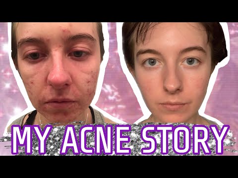 Accutane: Was It Worth The Risk? (My Story)