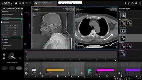 ct cerebral angiography ct siemens go now
