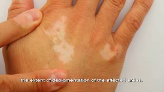 What Is Vitiligo? What Are Some of The Effective Treatments for It?