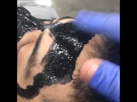 A remoção de bystry pigmentary nota em uma cara