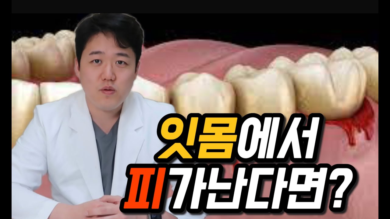 잇몸에서 피가나는 분 주목해주세요 40대 50대 풍치 원인은? 잇몸치료 비용과 치료방법 - YouTube