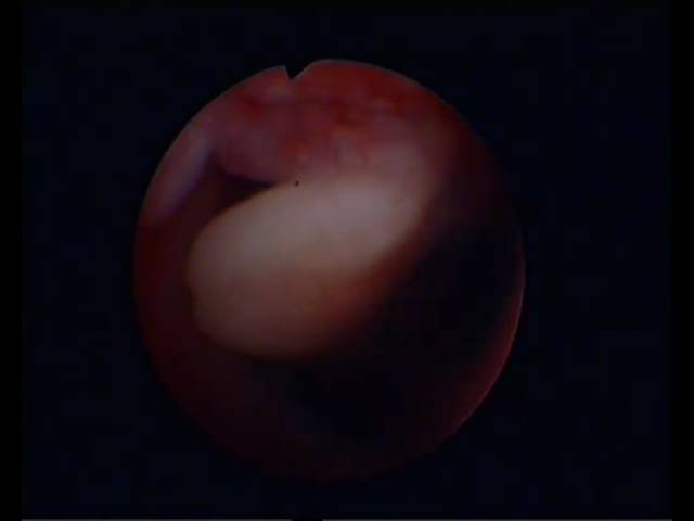 Анэмбриония - отсутствие эмбриона в плодном мешке