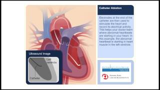 Catheter Ablation Animation Video