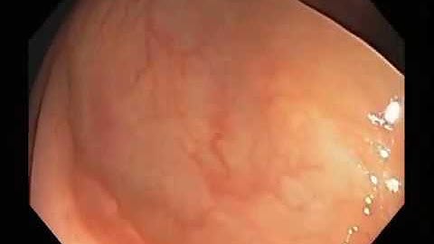 Automatic Detection of Polyp in Endoscopy / colonoscopy