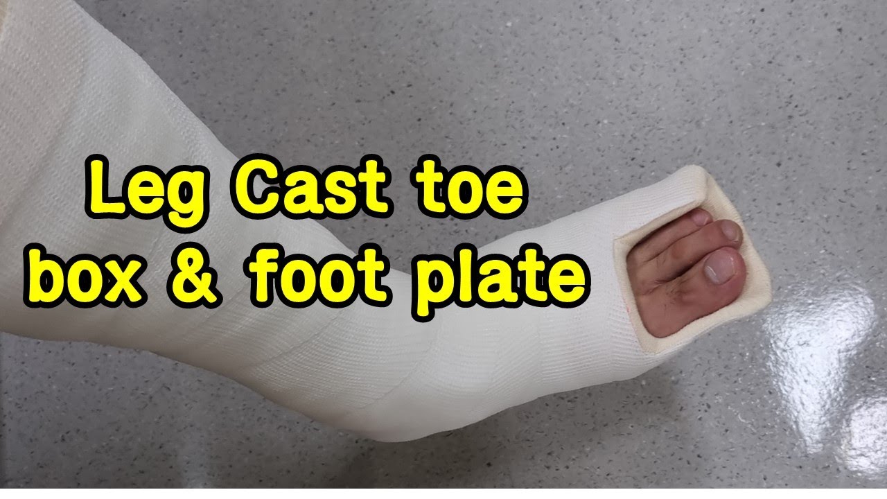 Short Leg Cast toe box foot plate YouTube