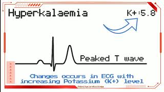 Hyperkalemia | ECG changes in hyperkalemia in 1 minute.