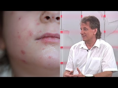 Video: Kūdikių Vėjaraupiai: Simptomai, Gydymas, Komplikacijos, Prevencija