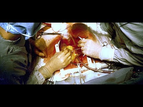 Video: Pirmo Reizi ķirurgi Varēja Veiksmīgi Veikt Sejas Un Roku Transplantāciju