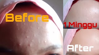 KEMPES SEKETIKA!!! KAPOK COBA YANG ABAL2 || OBAT JERAWAT PALING AMPUH TANPA PHP