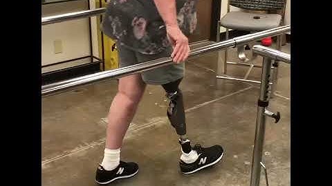 Above Knee  Amputee gets Newly Designed Double Wall Socket