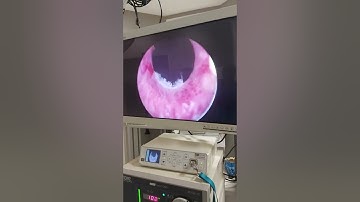 Bladder Fulguration For Chronic Recurrent Cystitis | 14