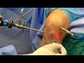 Multi ligamentous Knee Injury Arthroscopic Surgery | ACL &amp; MCL Injury Operation | ACL Reconstruction