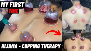 My First Hijama Cupping Therapy | Benefits Of Hijama