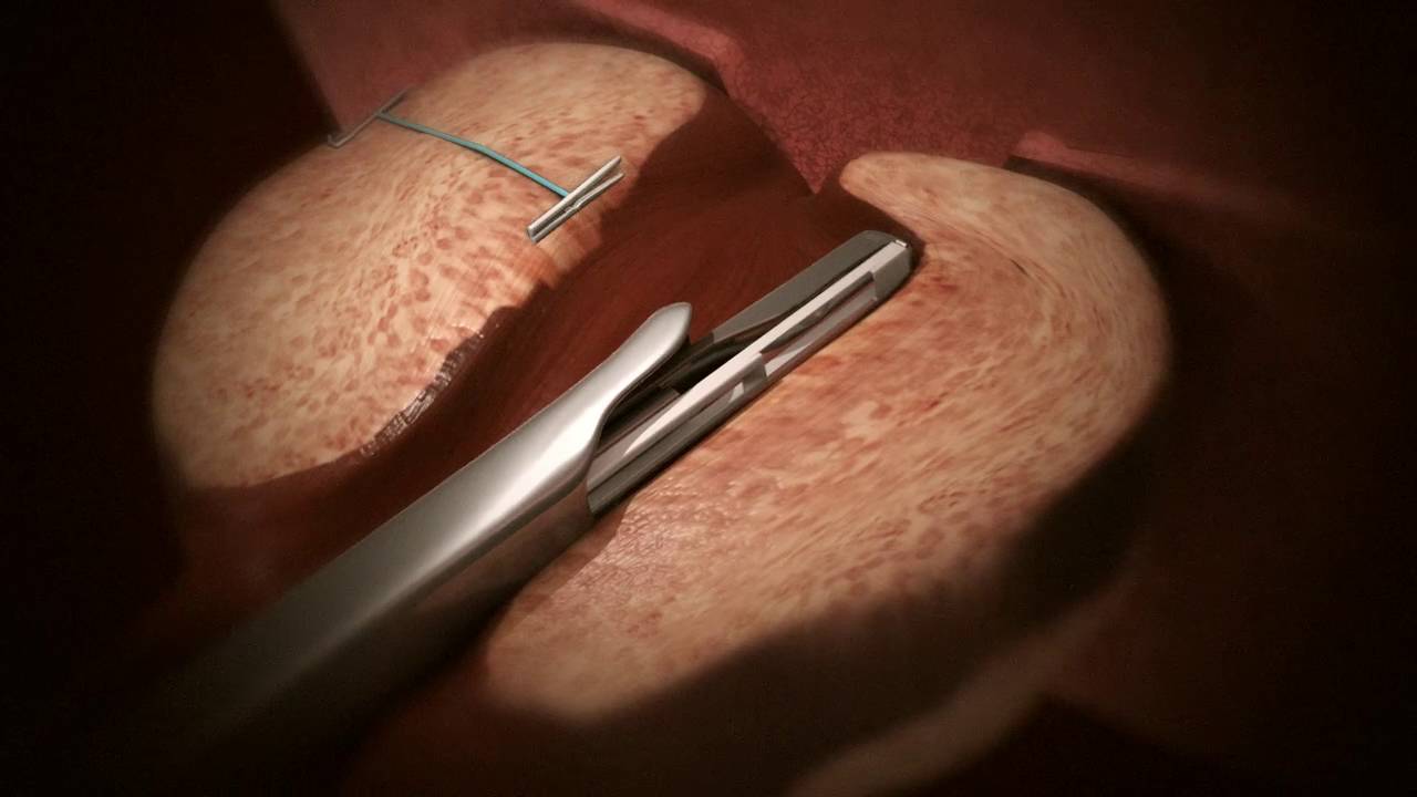 UroLift Procedure for BPH at Advanced Urology, P.C. YouTube