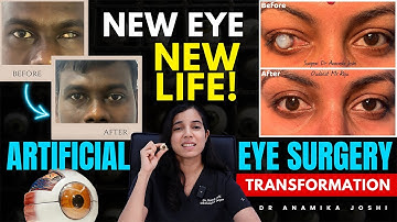 Artificial eye surgery : Everything you need to know | Artificial eye procedures | Dr Anamika Joshi