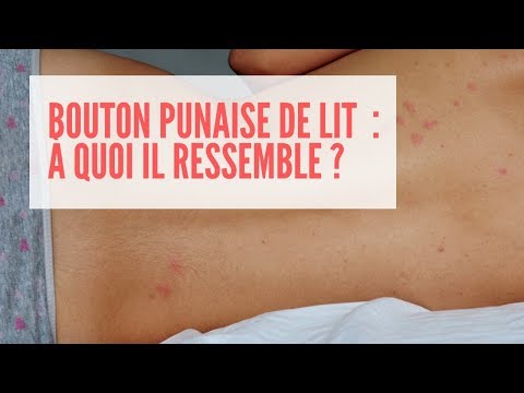 Vidéo: Les piqûres de puces sont-elles dangereuses ?