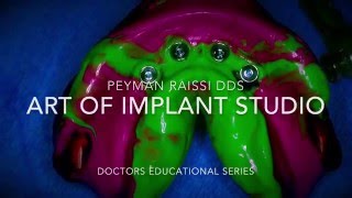 Impression technique for Full arch fixed Implant restoration & some personal pearls