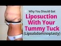 Mini Tummy Tuck Scar