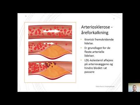 Arterielle lidelser del 1 af 5 hypertension, Arteriosclerose