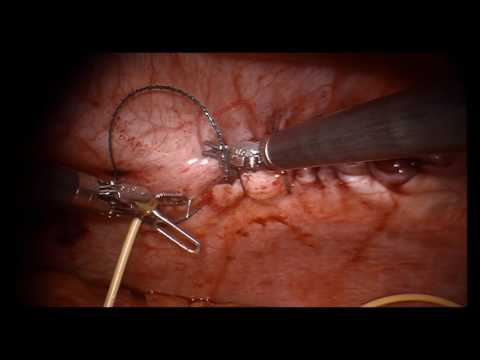 Robot-Assisted Incisional Hernia Repair In A Obese Patient With Ventriculoperitoneal Shunt