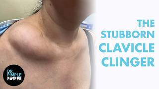 THE STUBBORN CLAVICLE CLINGER | Dr. Pimple Popper vs. a Large Lipoma