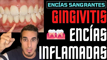 ¿Las encías vuelven a la normalidad después de una gingivitis?