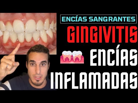 Video: Cómo reducir la inflamación de las encías (con imágenes)