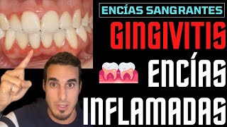 GINGIVITIS TRATAMIENTO y SÍNTOMAS - ENCIAS INFLAMADAS