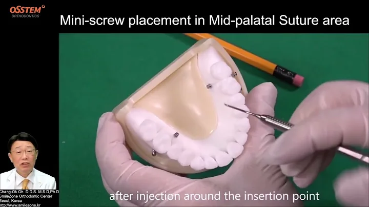6. Maxillary Mid Palatal & Rugae (When and How to use "Orthodontic Screw")