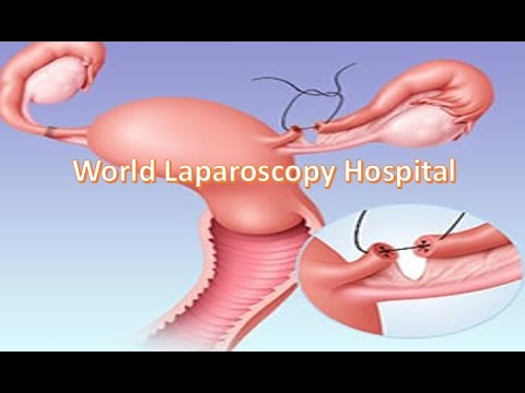 Laparoscopic Tubal Surgery