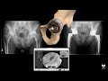 Revisiting the Autologous Graft for Acetabular Defects with Anterior Approach