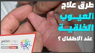 ما أنواع العيوب الخلقية لأصابع الأطفال دكتور وائل غانم يوضحها