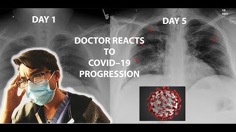 Doctor Reacts to COVID-19 Chest XRay Progression + CT
