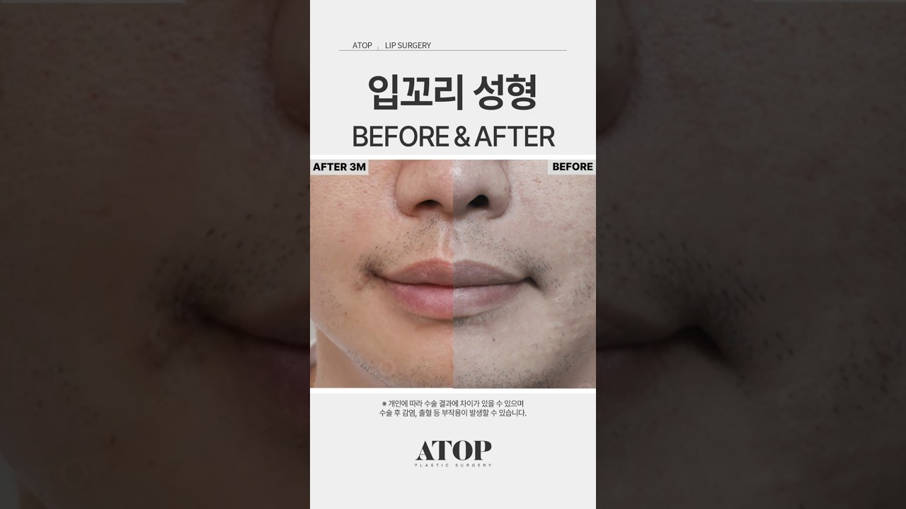 艾塔普整形外科 嘴角整形_術後分享2