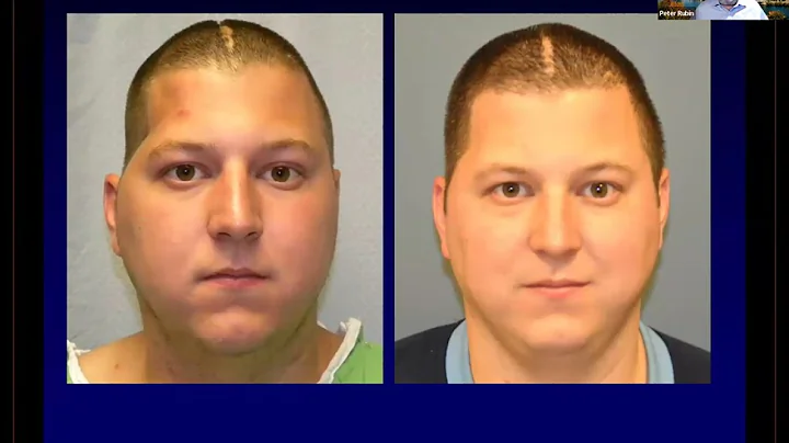 Hand in Hand Series Webinar: Autologous Fat Grafting for Upper Extremity Conditions