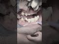 Scaling tartar and calculus of posterior tooth and composite restoratio #dentist #dental #dentistry