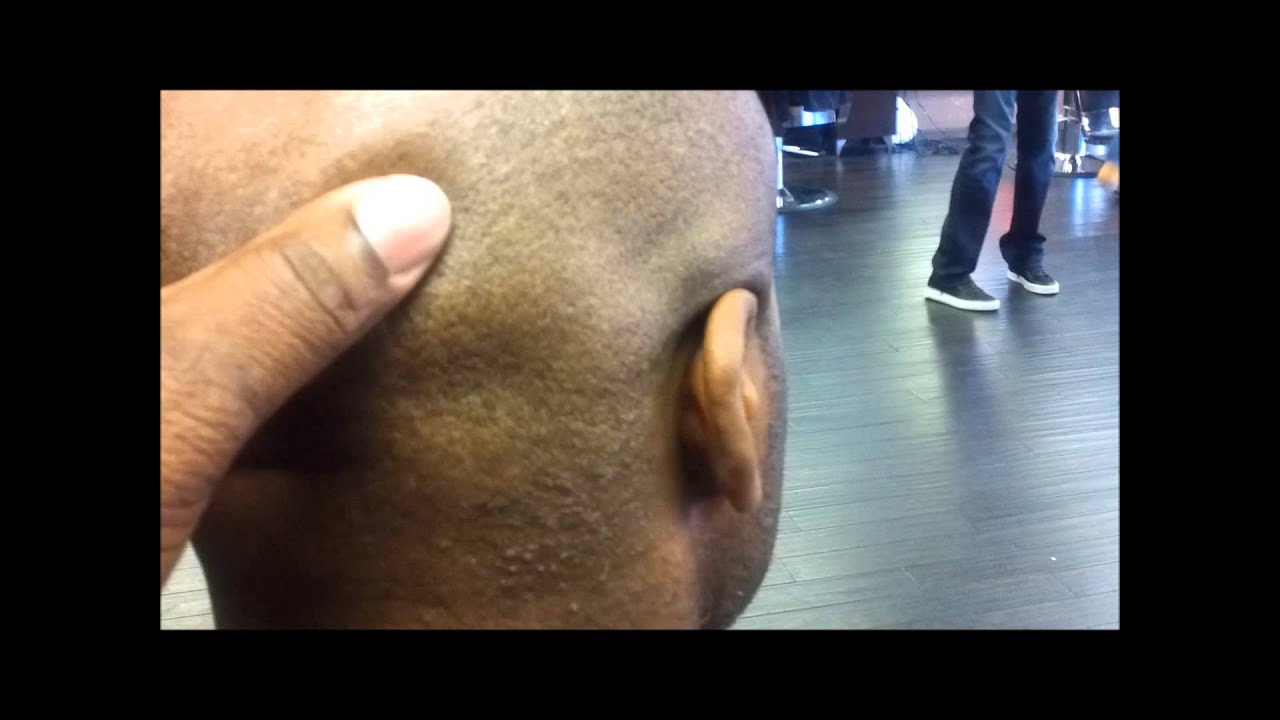 bald head razor bump treatment