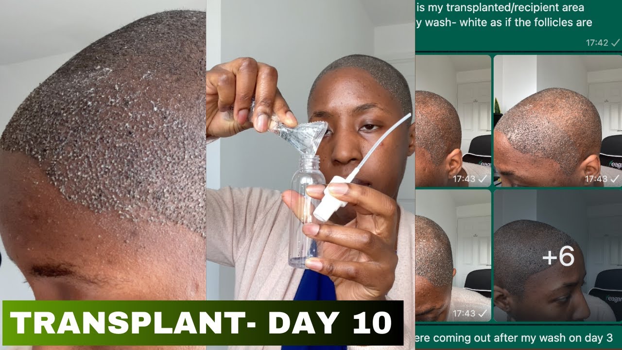 DAY 10 OF HAIR TRANSPLANT Follicles Coming Out? White Stuff, Saline