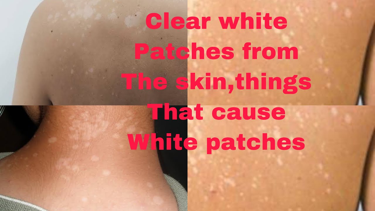 WHITE PATCHES ON THE SKIN,CAUSES OF WHITE PATCHES AND HOW TO PREVENT ...