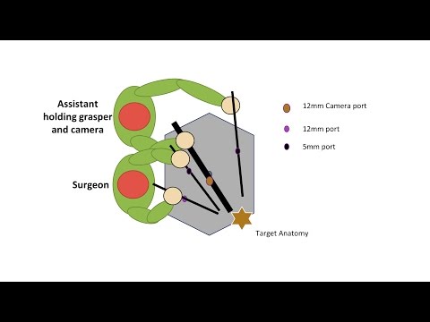 Learning Laparoscopic Sigmoid Colectomy (High Anterior Resection)