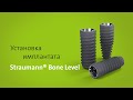 Установка имплантата: Straumann® Bone Level