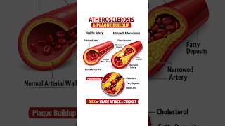 Atherosclerosis Explained: Plaque Buildup &amp; Blocked Arteries 🫀 #HeartHealth #Biology #MedEdu #Shorts
