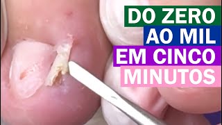 De zero a mil em menos de 5 minutos   [Renata Werneck Podóloga Unha Encravada REMOVE INGROWN NAIL]