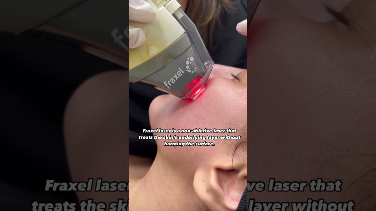 Laser treatment for youthful skin