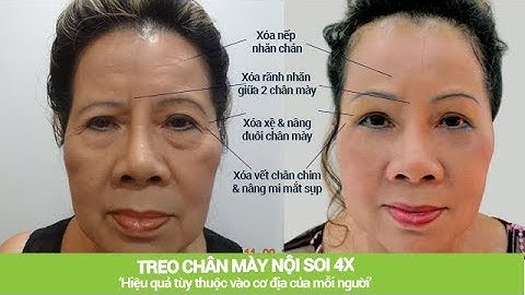 Treo chân mày nội soi 4X- Xóa nhăn trẻ hóa toàn diện vùng mắt